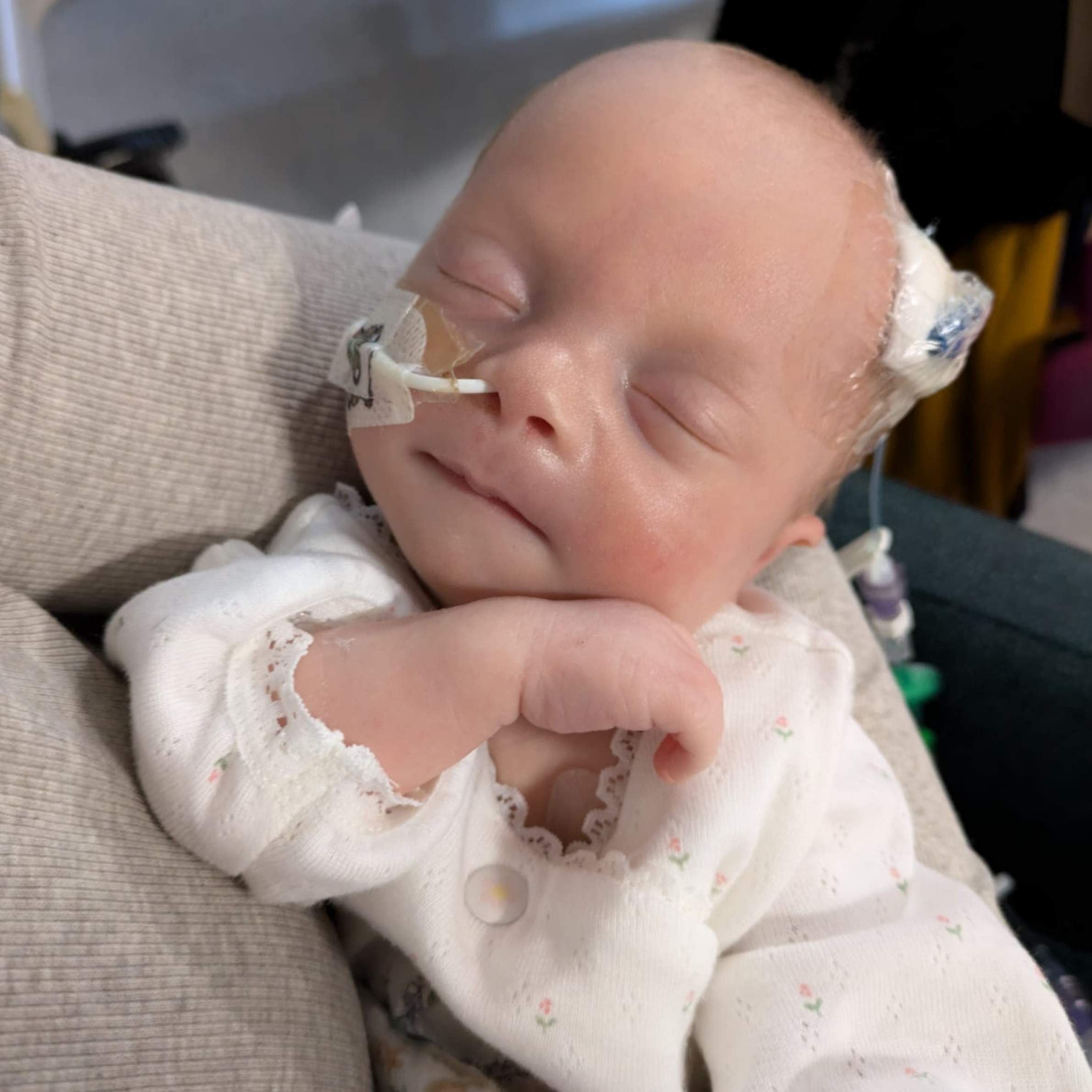 A young baby is in someones arms. The baby is wearing a white frilly babygrow. The baby has a tube from her nose and a bandage on her head.